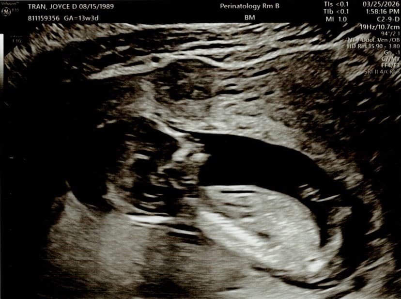 Ultrasound